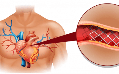 Angioplastia coronaria: recuperando la salud del corazón